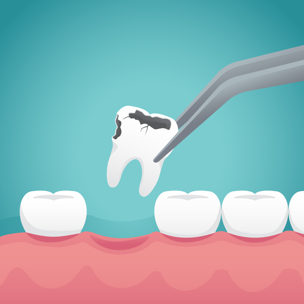 tooth extraction process