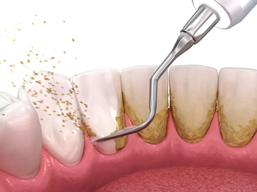 Dental Plaque Formation